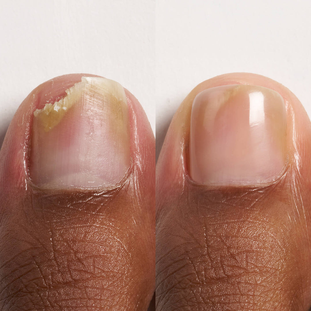 Comparison of a broken toenail and a manicured toenail with white polish after using CND BRISA on a light background.